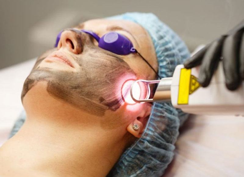 rejuvenecimiento facial con láser