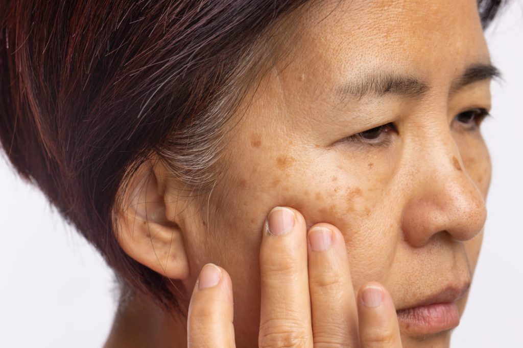Tipos de Melasma