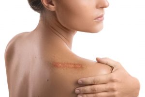 tratamiento cicatrices queloides